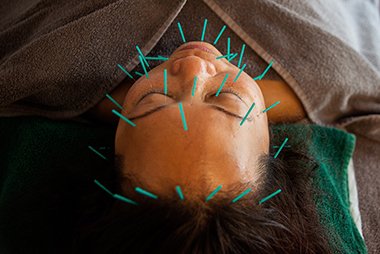 Cosmetic Acupuncture at top Wellness Studio in Poole Dorset