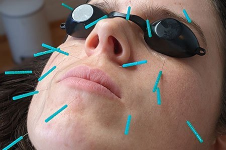 Acupuncture-and-LED-Light-Therapy-in-Poole-Dorset-at-Claires-Magic-Touch