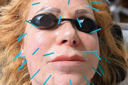 Acupuncture-experts-in-Poole-Dorset