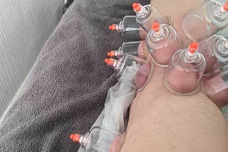 Dry-Cupping-with-Claire-Stanton-in-Dorset