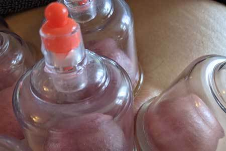 Dry-cupping-at-Claires-Magic-Touch-Studio-in-Poole