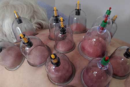 Dry-cupping-expert-in-Dorset-at-Claires-Magic-Touch-Studio