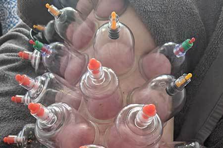 Dry-cupping-expert-in-Poole-Dorset