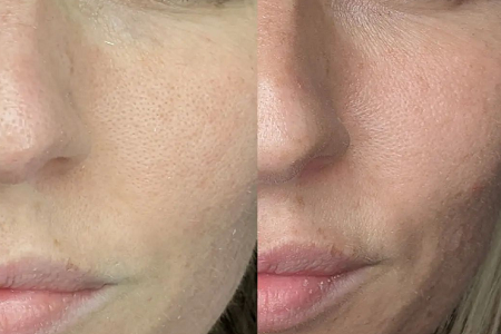 before-after-cosmetic-facial-acupuncture-in-Poole-Dorset
