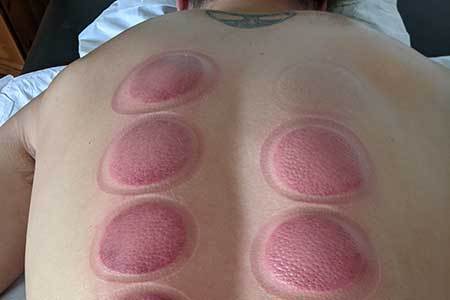 Dry-cupping-at-Claires-Magic-Touch-Clinic-in-Poole